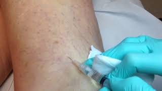 SCLEROTHERAPY