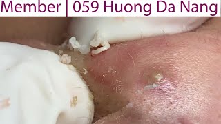 Acne Treatment Huong Da Nang# 059 |  Member