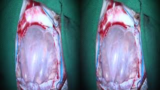 Microsurgical resection of an inferior cerebellar peduncle cavernous malformation...