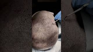 Hair Transplant in Care4Hair: painless!