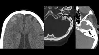 Complexed intracranial hemorrhage, pneumocephalus and skull fracture