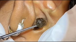 The Most Ear Wax Removal - Ear Cleaning ASMR - Satisfying Ear Cerumen -Relaxing Ear Treatment | #151