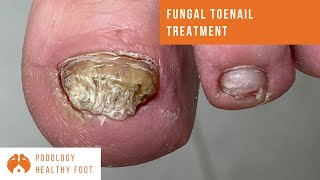 Fungal toenail treatment ***in a Relaxing ASMR***