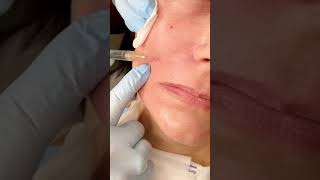 Intricacies of improving facial contours with fillers