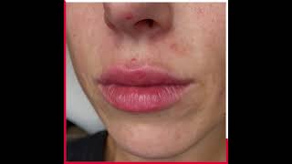 Lip Fillers - Dublin