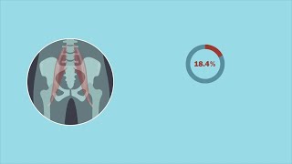 Radiographic Thigh Muscle Measurements Are a Reliable Predictor of Psoas Area and Sarcopenia