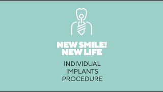 Individual implants and All On 4 treatment procedure