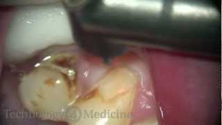 Class V Gingivectomy |  LightWalker Dental Laser