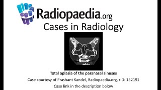 Total aplasia of the paranasal sinuses (Radiopaedia.org) Cases in Radiology