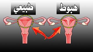 ازاي تعرفي ان عندك سقوط في الرحم / هبوط في الرحم ؟؟ تقويه عضلات قاع الحوض