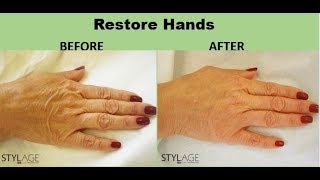 how to get younger looking hands with Stylage Hydromax Skin Booster