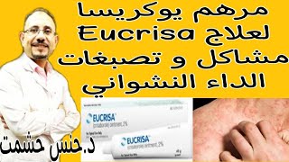 تفاصيل مرهم كريسابورول Crisaborole/إستخدامه و موانعه/آثاره الجانبية/حقيقة فعاليته للتصبغات النشوانية