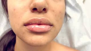 Lip Filler of the Day - Ageless MD