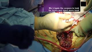 Extra-Large Penile Implant Using Subcoronal Approach by Dr. Hakky HD