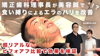 【美容鍼】食いしばりで発達した咬筋改善！？矯正だけじゃない美容の話【実体験レポ】