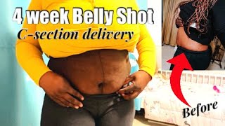 4 WEEKS POSTPARTUM BELLY SHOT | C-section Delivery