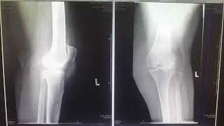 Clinical case- 5 June 2020 GSH TKR RA