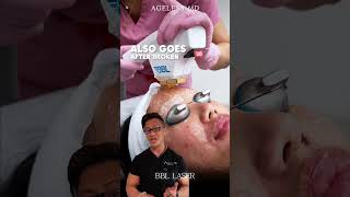 BBL For pigmentation #skin #skincare #agelessmd #aesthetics