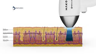 Como funciona o LASER 4D? Hakon | BCMED