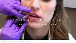 Juvederm Vollure - Lip Enhancement Demo - Skin by Lovely