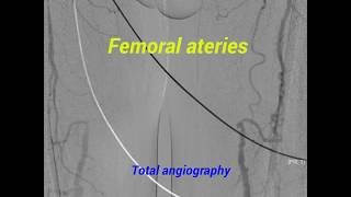 Total angiography