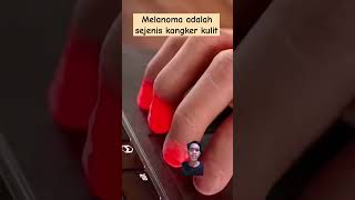 Melanoma adalah sejenis kangker kulit yang berbahaya 😨 #shorts #trending #faktaunik #faktamenarik