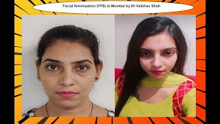 FFS before after in Mumbai! Face Feminization Surgery Before after