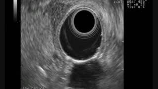 Pancreas ventral anlage