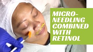 Microneedling combined with skin whitening retinol cream for age spots, melasma.