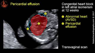 Fetal echocardiography at 11-13 weeks: Pericardial Effusion