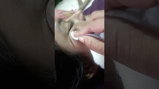 removing mini freckles #shorts #shortvideo #molesremover #jannatpramanik #minifrecklesremover