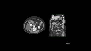 Case of the Week: The best dx in the pt with RLQ pain is?