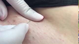 Мастер класс Удаление вросших волос Removing ingrown hairs Extracting blackheads