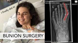 BUNION SURGERY I Would I do it again? Let's talk about: pain, scars, recovery ...