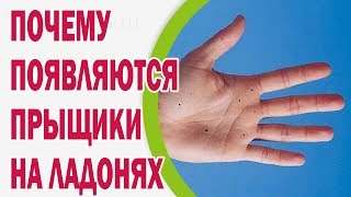 Почему появляются прыщики на ладонях