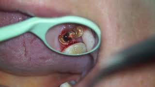 Surgical extraction of broken tooth under dental operating microscope