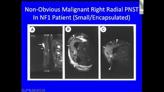 Peripheral Nerve Tumors: To Grow Or Not To Grow; To Operate Or Not To Operate...