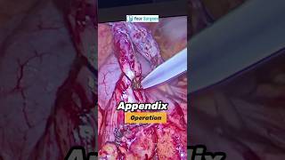 Appendix ka operation kaise hota hai ? Appendicitis Treatment I Appendix ka ilaj I Appendix bimari