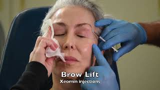 Xeomin injections facelift S