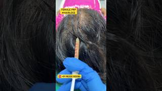 FEMALE HAIR PRP #female #hair #prp #ytshorts #shorts #hairgrowth #hairlosssolution #haircare