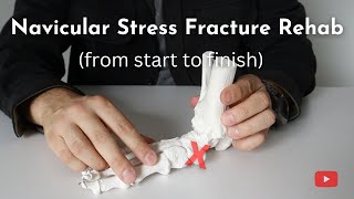 Navicular Stress Fractures | Causes, Diagnosis, and Treatment