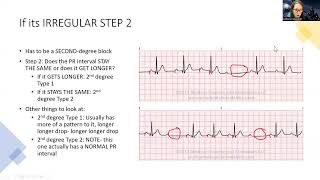 Complex: How to figure out which heart block in 2 steps