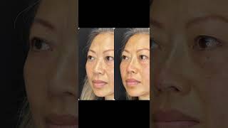 Amazing PDO Nose Bridge + Tip Lift Done by Dr. Tsay - Ageless MD