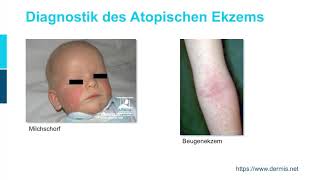 Dermatologie ─ Atopische Dermatitis Teil 1/2