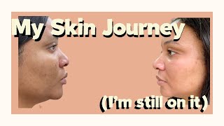 How I Transformed My Skin | pigmentation | Acne | Skin Care Routine