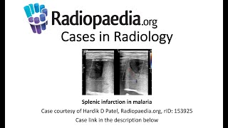 Splenic infarction in malaria (Radiopaedia.org) Cases in Radiology