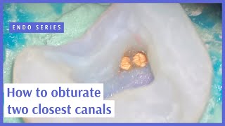 How to obturate two closest canals