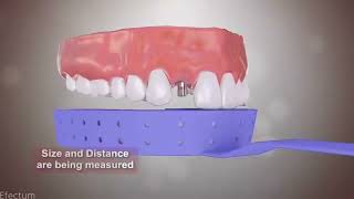 كيف تتم زراعة الاسنان #dranwar How to implant_teeth#