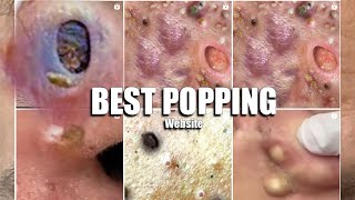 America's #1 Pimple Popping Website