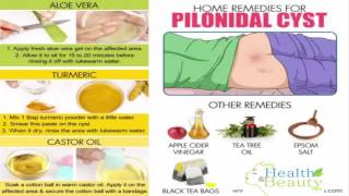 Home Remedies for Pilonidal Cysts